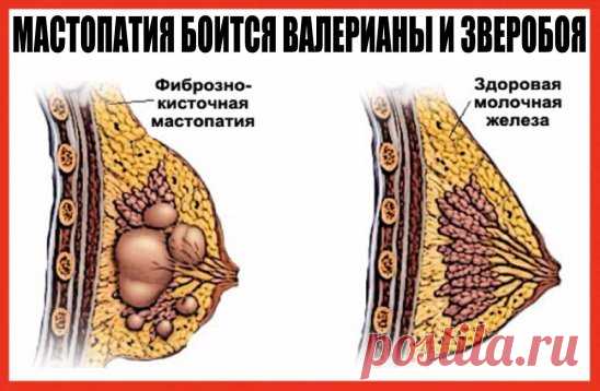 МАСТОПАТИЯ БОИТСЯ ВАЛЕРИАНЫ И ЗВЕРОБОЯ
Услышав от врачей диагноз «мастопатия», многие женщины впадают в отчаяние. И не случайно. Большинство не знает, как это заболевание лечить и как с ним жить. Доктора зачастую никакого лечения не предлагают. Советуют лишь проверять молочные железы каждый год, а вот если уплотнение начнет расти, тогда … придется, видимо, оперировать. Утешение, сами понимаете, слабое. А вот народная медицина знает немало естественных средств, с помощью которых можно облегчить с