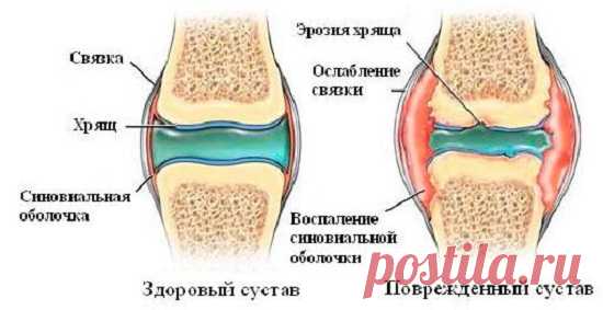 Лучшие народные рецепты для лечения суставов