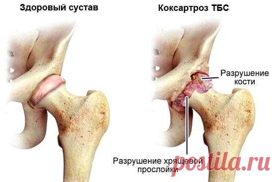 Гимнастика Евдокименко для тазобедренных суставов: лечение артрита и коксартроза с видео