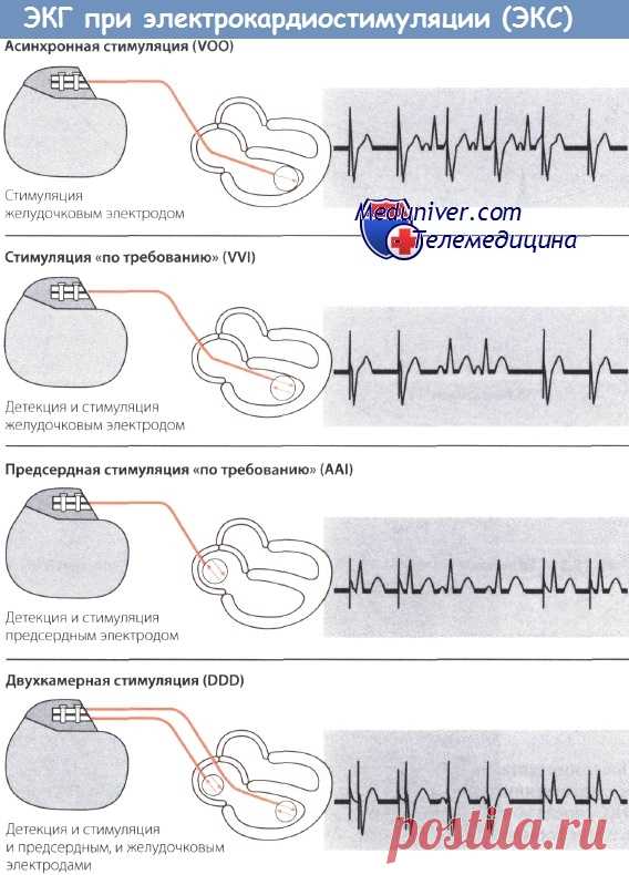 ЭКГ при однокамерном кардиостимуляторе по требованию (в режиме demand, VVI)