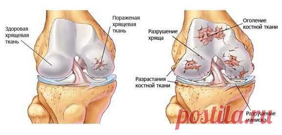 Почему хрустят суставы. Что мы должны об этом знать.