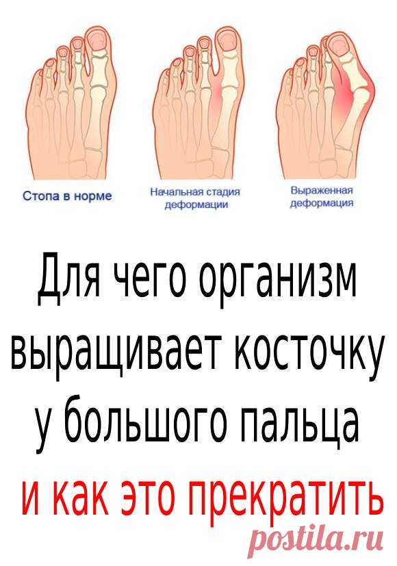 Косточка у большого пальца (hallux valgus) - это... ✅ Нажмите ЗДЕСЬ , чтобы ОТКРЫТЬ !