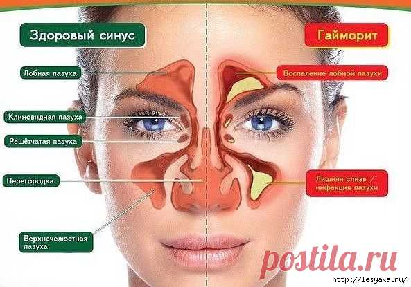 Супер-капли от гайморита и затяжного насморка своими руками!