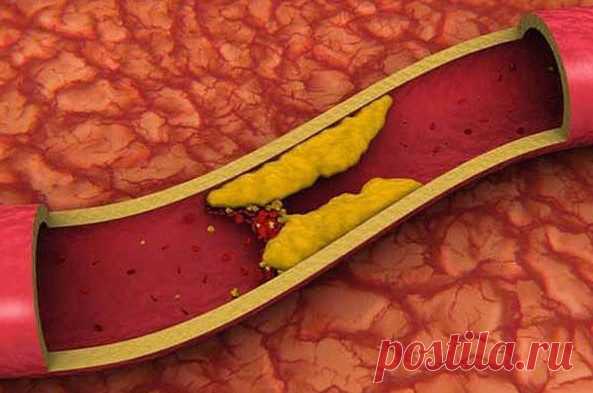 5 естественных способов снизить уровень плохого холестерина за 4 дня / Будьте здоровы