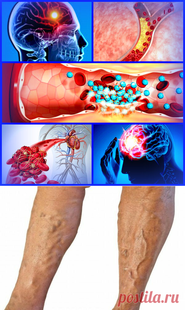 Откуда берутся тромбы и насколько они опасны? | Здравник | Яндекс Дзен