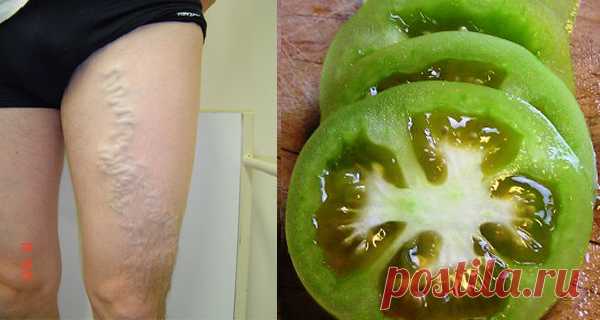 А вы знаете, что зеленые помидоры могут помочь в лечении варикозного расширения вен? Воспользуйтесь удивительными лечебными свойствами помидор и получите облегчение!