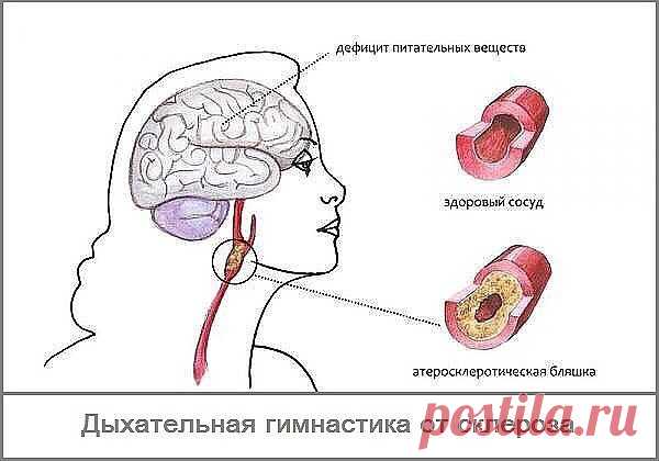 #Мое_здоровье#
Дыхание от склероза - дыхательная гимнастика Л.А.Анисимова.

Эта гимнастика помогает при самых разных заболеваниях, в частности, склерозе сосудов головного мозга и инсульте.Буквально через месяц серьёзных занятий вы почувствуете,что находитесь на верном пути. .Сначала следует выбрать позу: или полулежа в кресле, или на спине - кому как удобно. Расслабьтесь, отбросьте все житейские заботы и приступайте.Закрываем пальцем левой руки левую ноздрю и спокойно, оче...