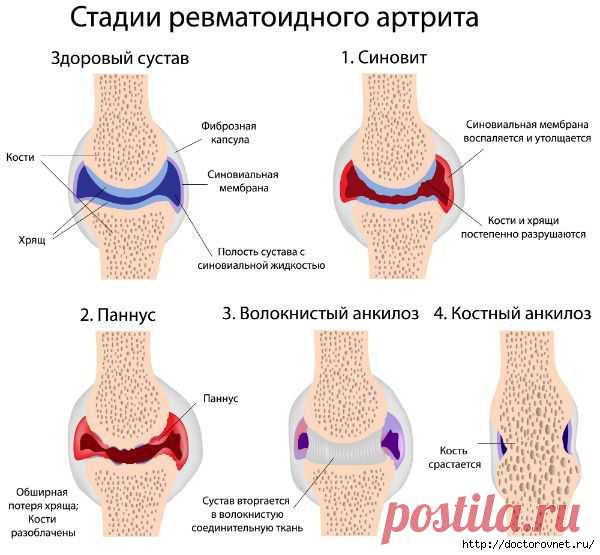 СУПЕРЛЕЧЕНИЕ. КАРТОФЕЛЬ НА КЕФИРЕ ПРОТИВ АРТРИТА