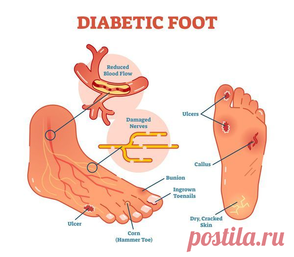 Диабетическая стопа: симптомы и лечение, стадии, уход за ногами