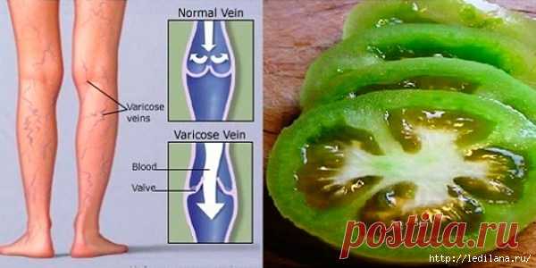 Как можно вылечить варикозное расширение вен 2 помидорами?