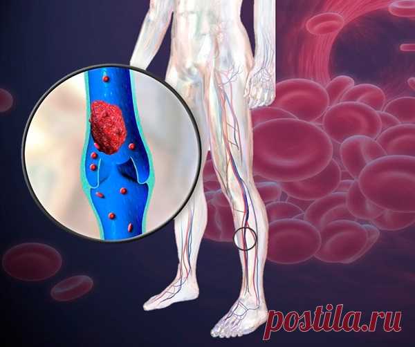 Тромб, который может вас убить мгновенно: 15 опасных признаков