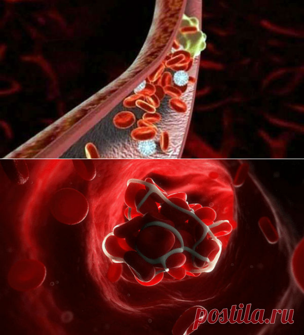 Коронавирус тромбы. Профилактика тромбозов артерий.