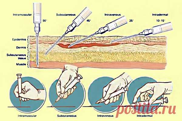 А вы знаете под каким углом делать инъекции? Наглядная простая инструкция