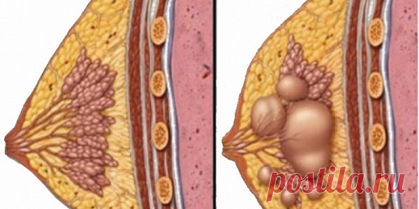 Вы не должны ложиться под нож: Лечение любых видов кист теперь возможно с этим рецептом!
