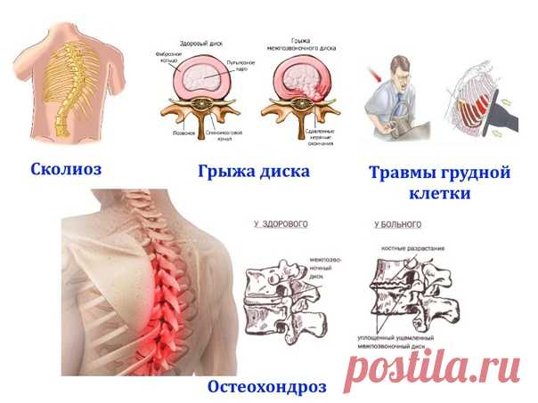 Почему возникают боли в груди и в районе лопаток?
Снижается высота дисков из за падений,травм,поднятия тяжестей.
Защемляются корешки спинного мозга.
Появляются жесткие блоки и напряжение в мышцах.
Нарушается кровоток по всему телу!
Запись к мануальному терапевту в Спб +7-931-360-16-23