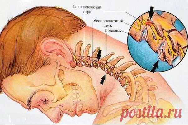 Восемь упражнений против шейного остеохондроза