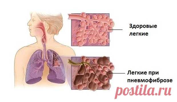 Пневмофиброз легких: как лечить, диффузный, базальный и линейный вид