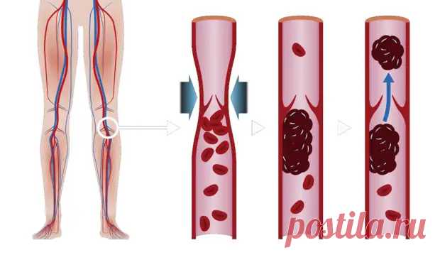 Признаки и симптомы тромбоза глубоких вен - ПолонСил.ру - социальная сеть здоровья - 25 июля - 43982227798 - Медиаплатформа МирТесен