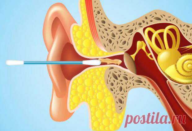 Ватные палочки предназначены только для наружного применения — их нельзя вставлять в ухо. Как же тогда почистить ушные проходы от чрезмерного скопления серы? В статье мы описали несколько самых оптимальных и эффективных вариантов. 1. Используйте физиологический раствор Ингредиенты 1/2 стакана
