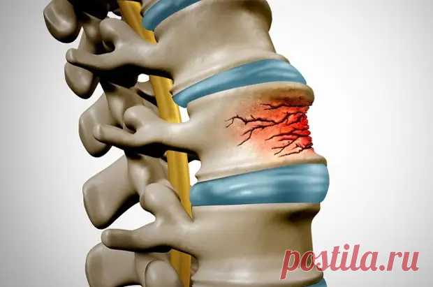 Бессимптомно годами. Врач открыла первый точный признак остеопороза - ПолонСил.ру - социальная сеть здоровья - 21 октября - 43250805711 - Медиаплатформа МирТесен