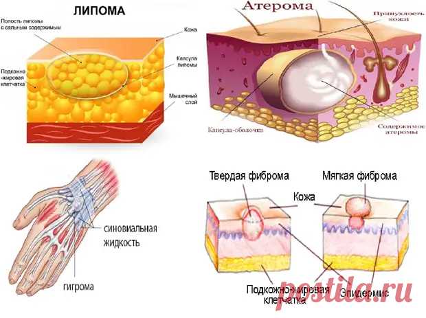 (21) Липомы, атеромы, гигромы и фибромы кожи – что это такое? - ПолонСил.ру - социальная сеть здоровья - 11 декабря - 43764620497 - Медиаплатформа МирТесен