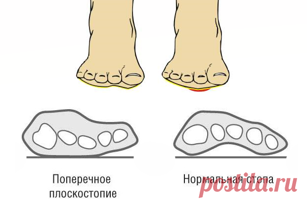 Коррекция поперечного плоскостопия | Доктор Гульнара Мазитова | Яндекс Дзен