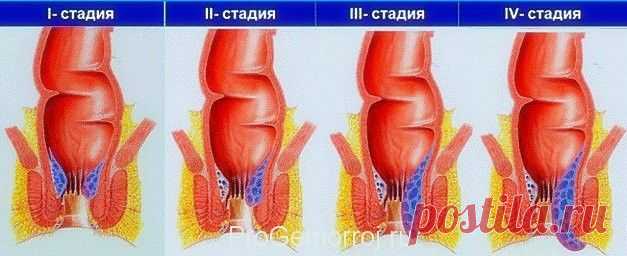 Геморрой. Как справиться с болезнью