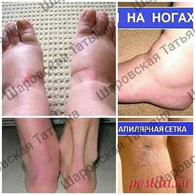 #ноги #отечность #варикоз Два месяца и ваши ножки, как у горной лани.