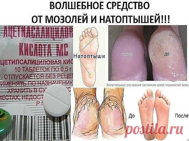 Жесткие мозоли на пятках, их еще называют 