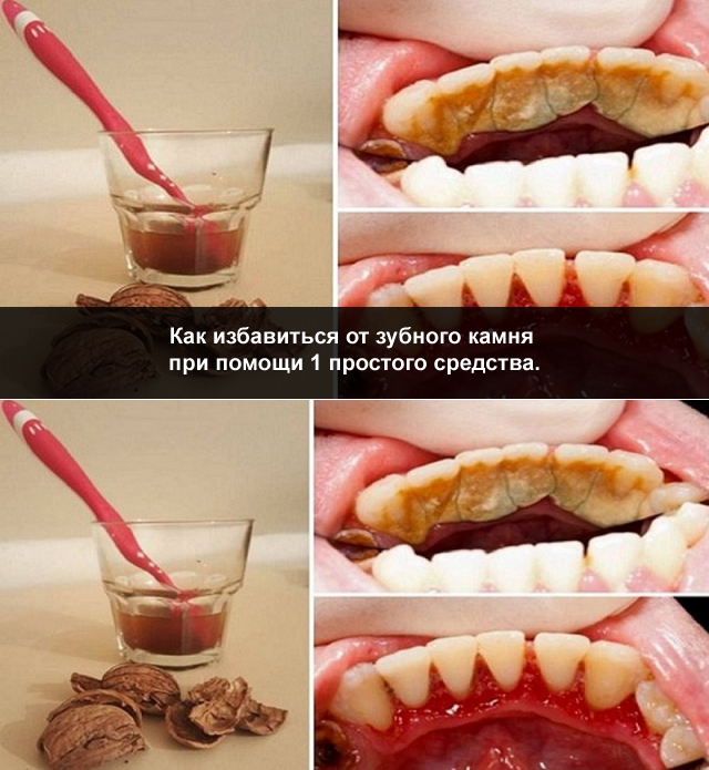 Что кушать после чистки зубов. Зубной какамекакамень.