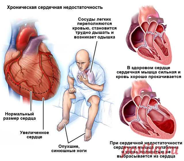 Ингибиторы АПФ: список препаратов, что это такое и механизм действия