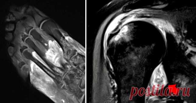 Обнаружены причины продолжительной мышечной и суставной боли при COVID-19 Рентгенологические снимки подтверждают, что «COVID-19 может заставить организм атаковать сам себя».
