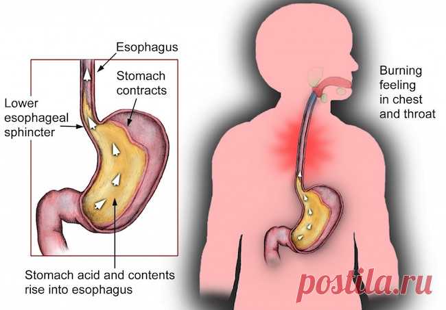 Естественные способы, чтобы управлять кислотного Рефлюкса Жгучая боль в груди, что кислый вкус резервное копирование в рот . . . кислотный рефлюкс чувствуется и на вкус ужасный, особенно если вы часто испытываете его.
