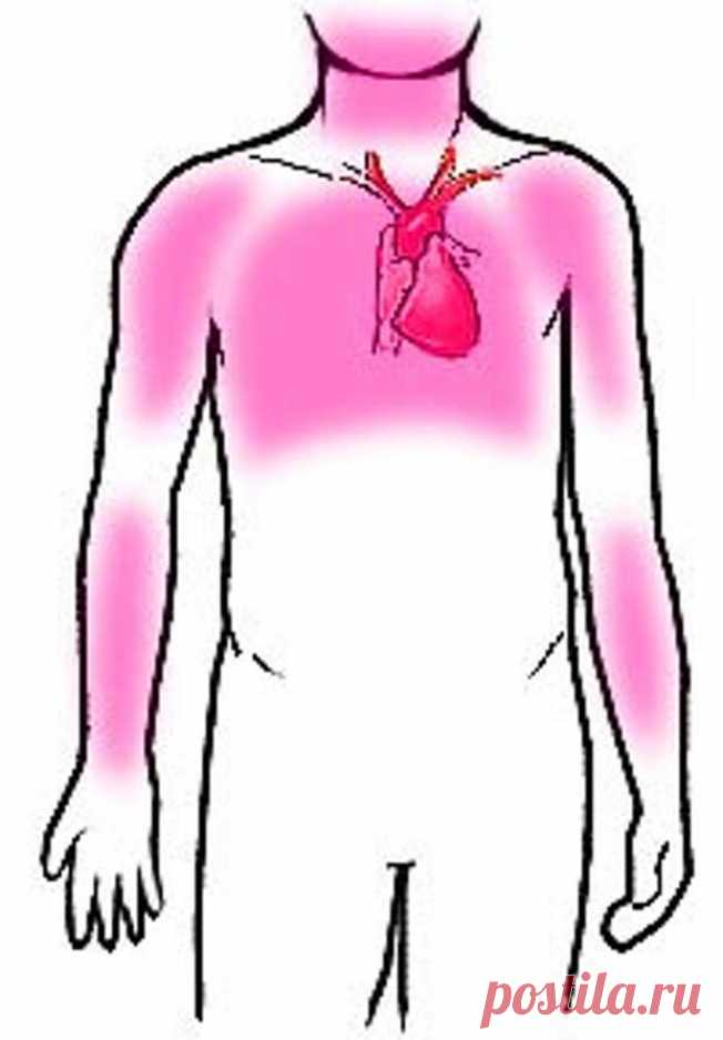 Иррадиация в область сердца