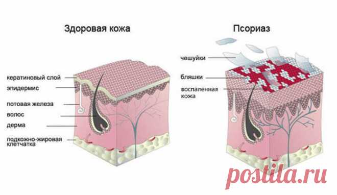 Псориаз — не заболевание кожи!