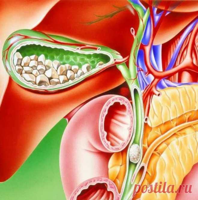 Советы восточной медицины при холецистите Кто не любит вкусно поесть! Солененькое, жирненькое, остренькое… Но привычка к порочному питанию ведет к такому заболеванию, как холецистит (или воспаление желчного пузыря).
