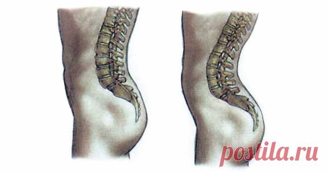 Поясничный лордоз – причины развития и способы лечения Поясничный лордоз симптомы, лечение, упражнения.