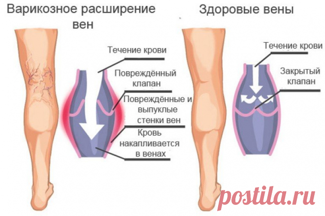 Ноги без варикоза - это реально!