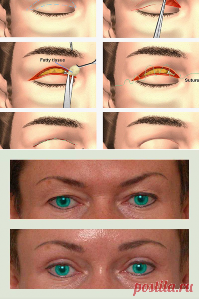Блефаропластика верзн их век. Блефаропластика верхних век. Блефаропластика верхних век реабилитация. Блефаропластика верхних век реабилитация по дням.