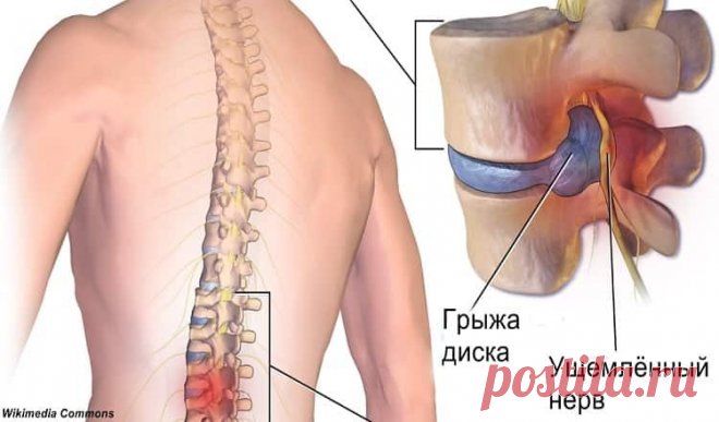 Хирург отговорил меня от операции и посоветовал делать эту зарядку! И ведь помогло!