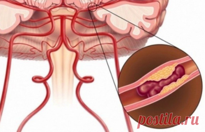 Как распознать микроинсульт и принять соответствующие меры? Нарушения в деятельности сердечнососудистой системы являются достаточно распространенной проблемой среди современного населения. Такие недуги развиваются по самым разным причинам, они одинаково часто …