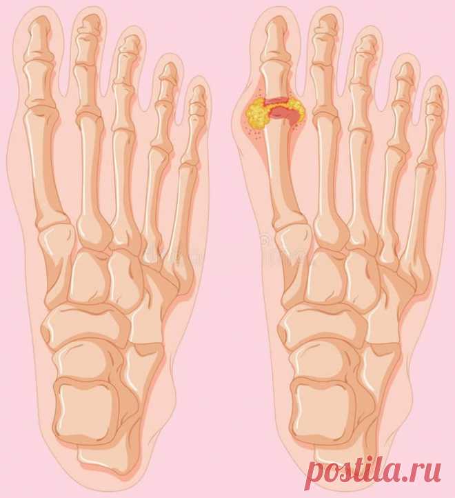 Что нужно знать о подагре / Будьте здоровы