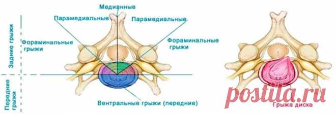 Фораминальная грыжа: первые симптомы, лечение, восстновление
Боли в спине случаются у каждого, особенно при неосторожных движениях. Однако зачастую они могут быть показателем серьезных заболеваний, таких как фораминальная грыжа. Фораминальная — это межпозвоночная грыжа, при которой межпозвоночное содержимое выпячивается в сторону спинного канала, зажимая при этом нервные окончания.