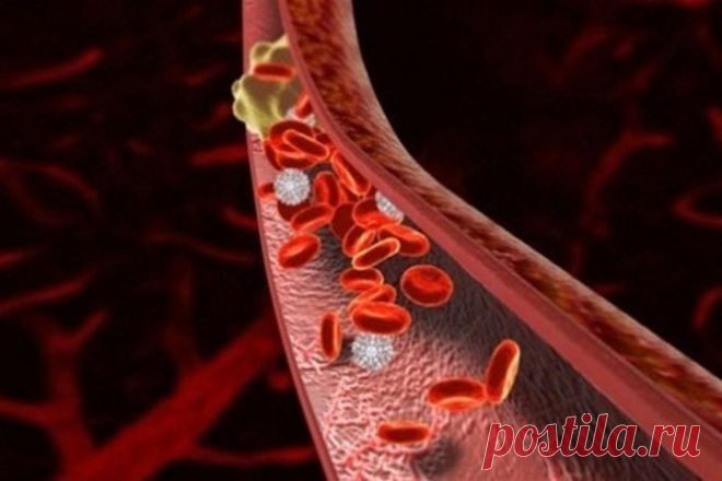 Почему отрывается тромб: исследуем симптомы и провоцирующие факторы | ПолонСил.ру - социальная сеть здоровья