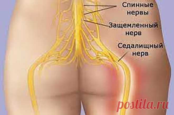 Воспаление седалищного нерва: достаточно 1 легкого упражнения, чтобы избавиться от боли всего за 5 минут!