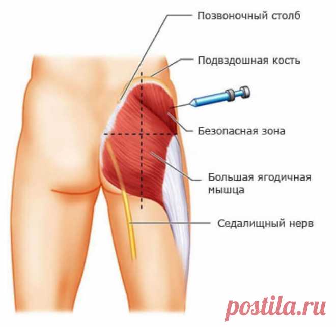 Как правильно делать инъекции? Сохраните себе эту важную информацию!