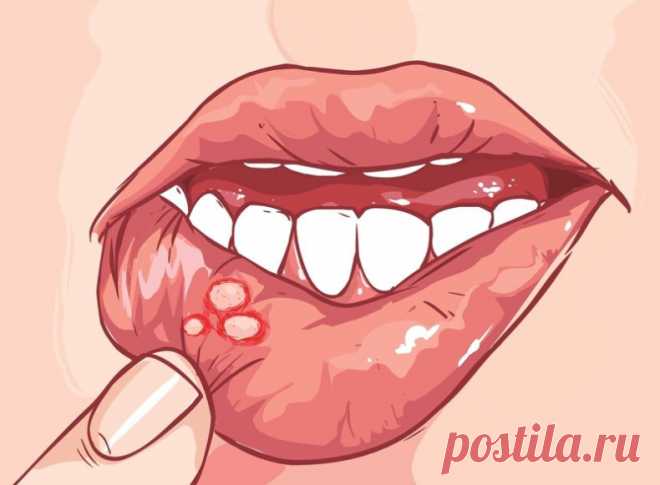 Стоматит — это воспаление слизистой оболочки рта. Есть несколько видов стоматита. Это язвенный, афтозный, везикулярный, герпетический и другие. Герпетический выглядит просто отвратительно. 
 
Самый частый — афтозный; это когда образуются такие маленькие язвочки на слизистой оболочке. Они противно щиплют, стоит пище попасть в рот, а также их всё время хочется потрогать языком (что только замедляет заживление). Конечно же, их ни в коем случае нельзя касаться пальцами и уж те...