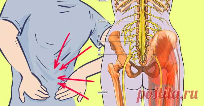 Попрощайся с седалищной невралгией за 10 минут, познакомившись с этим естественным способом!  Подойдет всем, кто ведет сидячий образ жизни...