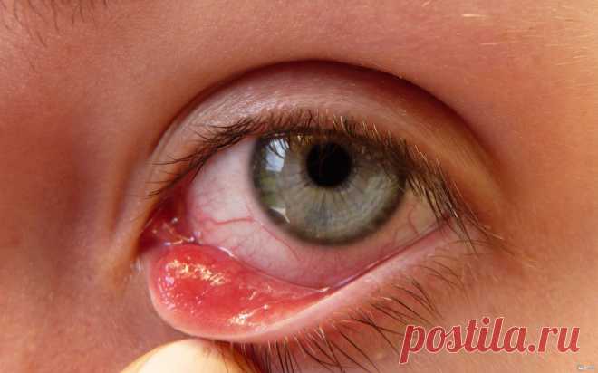 Как лечить ячмень на глазу ? 
Ячмень на глазу появляется в результате острого гнойного воспаления путем инфицирования волосяного мешочка ресницы. Принято полагать, что под глазом ячмень возникает из-за переохлаждения организма. Н…