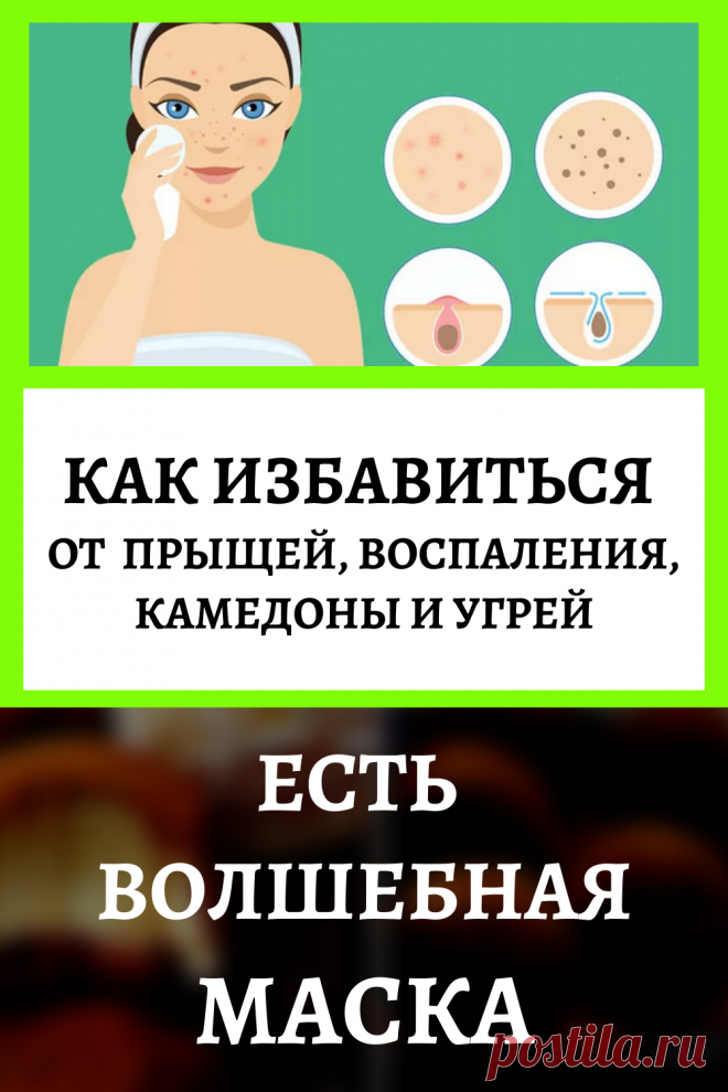 Как избавиться от прыщей, воспаления, камедоны, угрей. Есть «волшебная» маска